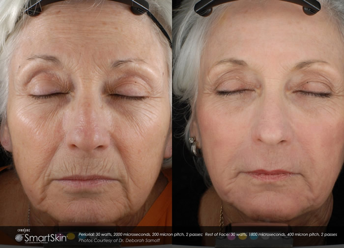 Laser Skin Resurfacing CO2, Facial Rejuvenation | Advanced ...