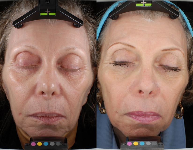 Before and After Dermatology PhotosAdvanced Dermatology &amp; Skin Care ...