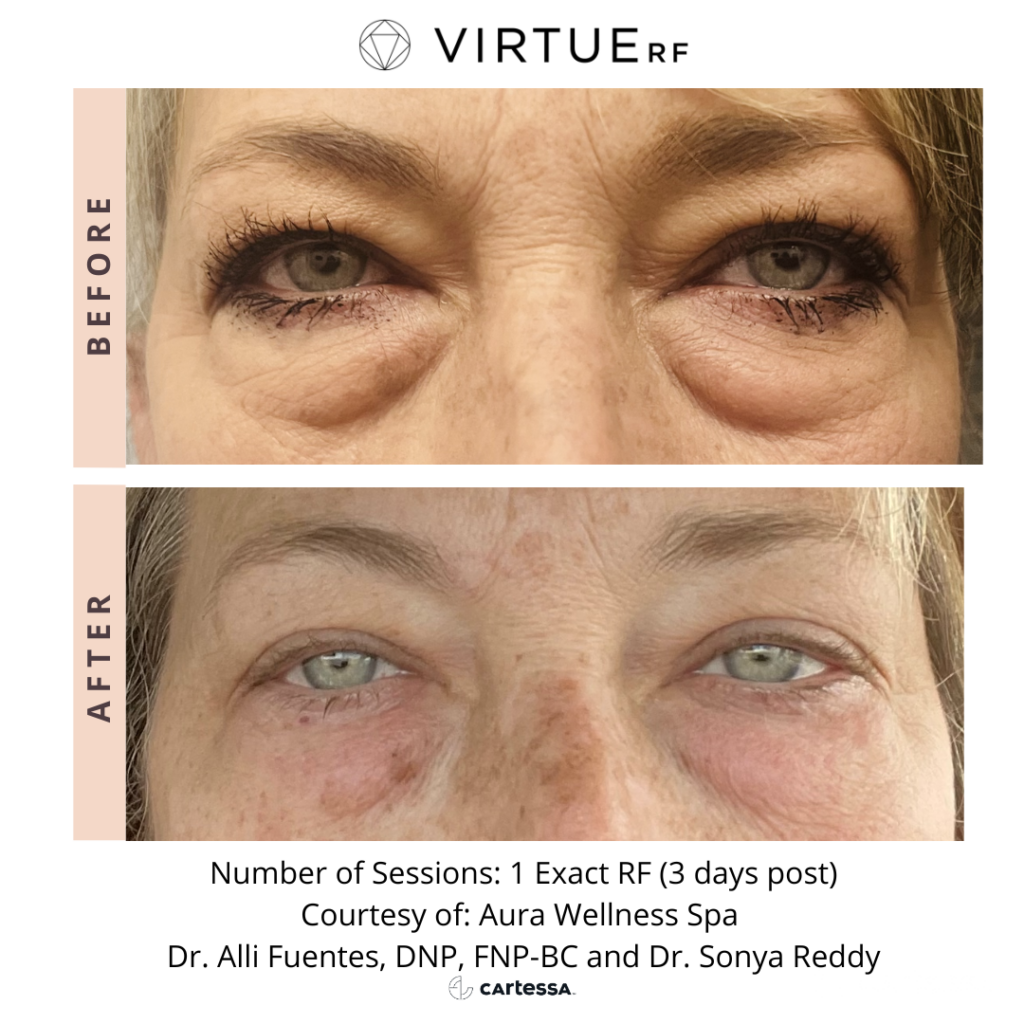 Virtue RF Microneedling Advanced Dermatology And Skin Care Center