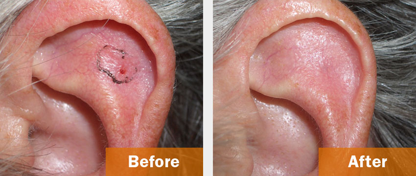 squamous cell carcinoma ear