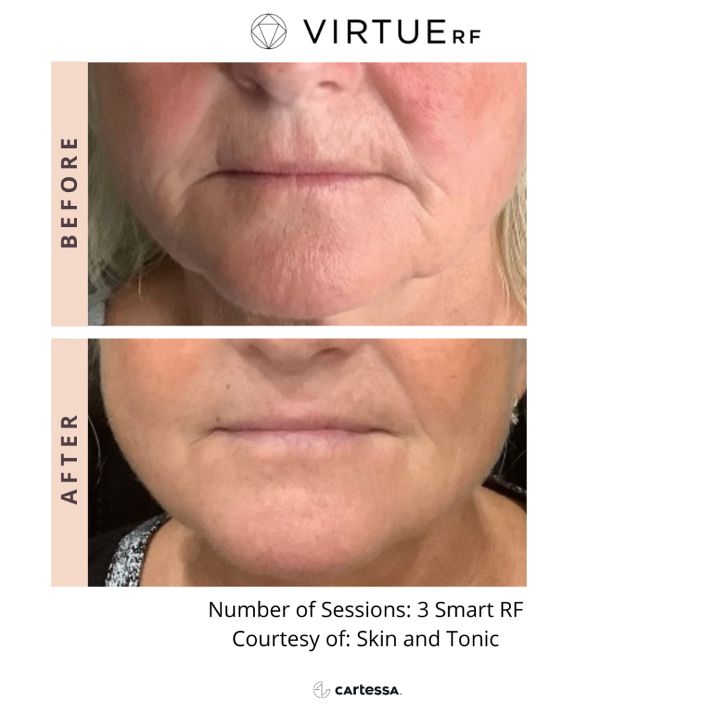 Virtue RF Microneedling - Advanced Dermatology And Skin Care Center